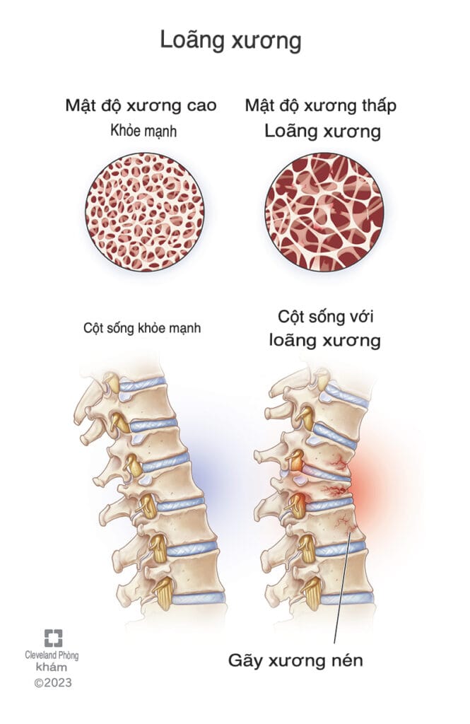 mật độ xương bình thường và loãng