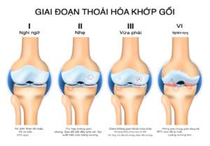 4 giai đoạn thoái hoá khớp gối